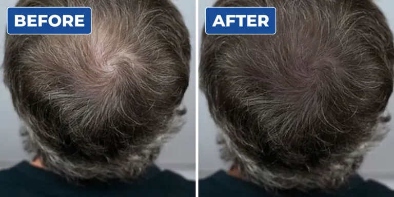 Top view before and after scalp micropigmentation adding density to a man's thinning crown with grey hair