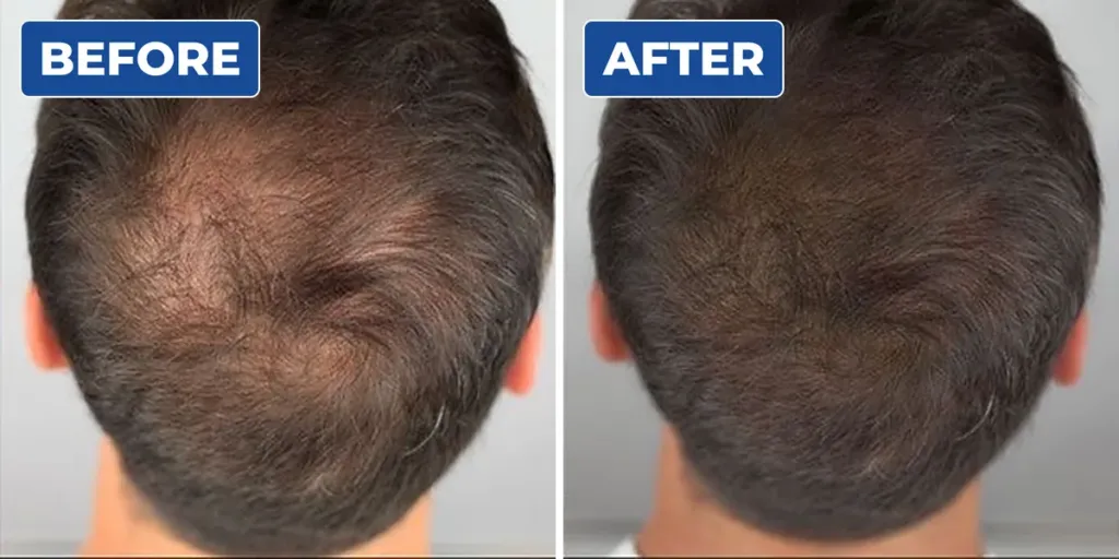 Top view before and after scalp micropigmentation on a man's thinning crown, showing a denser look