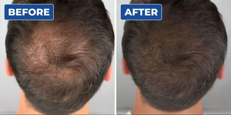 Top view before and after scalp micropigmentation on a man's thinning crown, showing a denser look