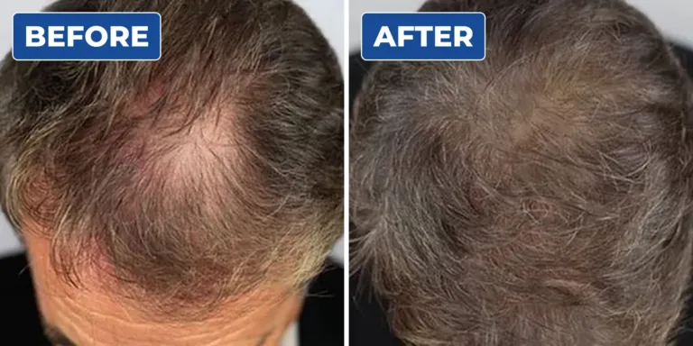 Before and after scalp micropigmentation on a man's thinning grey hair, adding density across the crown