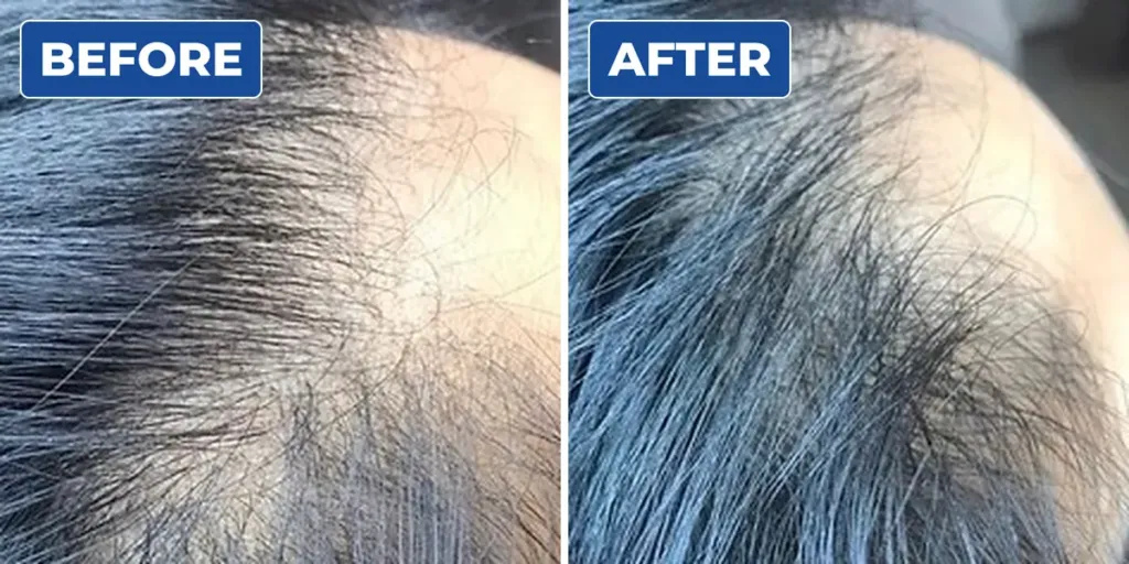 Before and after scalp micropigmentation for a woman with thinning hair at the crown, showing a denser look