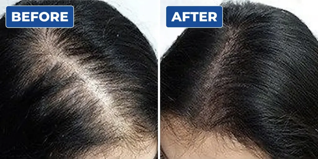 Before and after scalp micropigmentation for a woman with a widening hair parting, showing a denser look