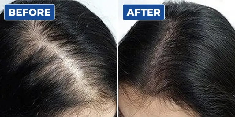 Before and after scalp micropigmentation for a woman with a widening hair parting, showing a denser look