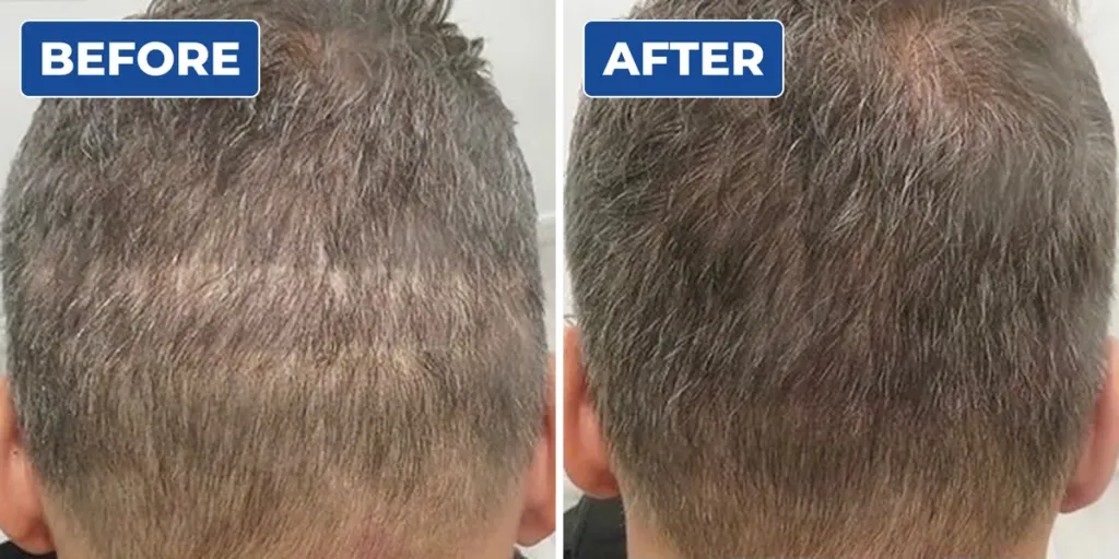 Before and after scalp micropigmentation adding hair density to thin patches at the back of a man's head