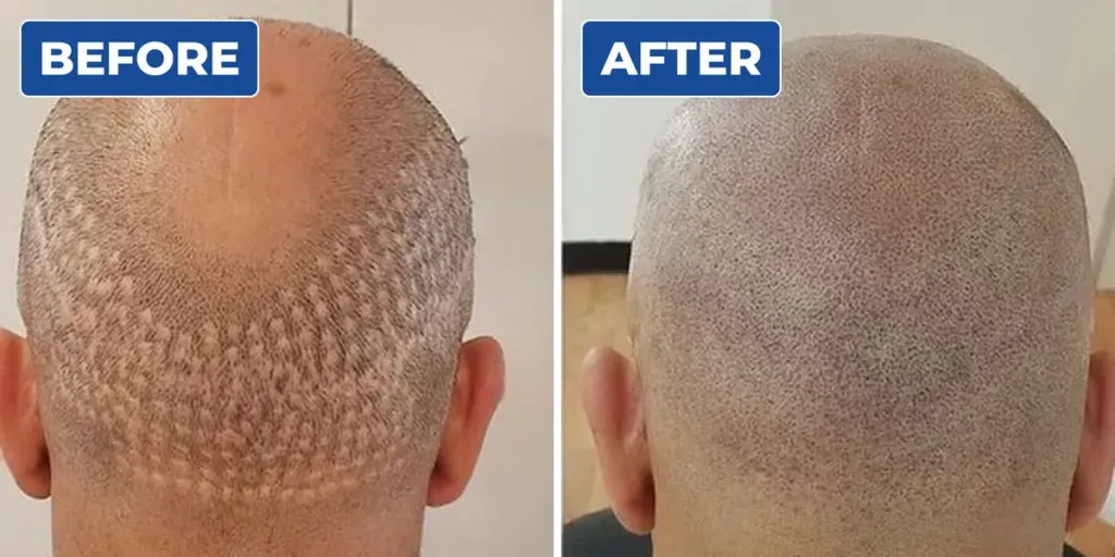 Before and after scalp micropigmentation camouflaging hair transplant scarring on the back of a man's head