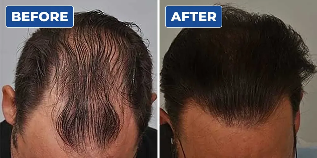 Before and after scalp micropigmentation for a man with a receding hairline and thinning top, giving a fuller look