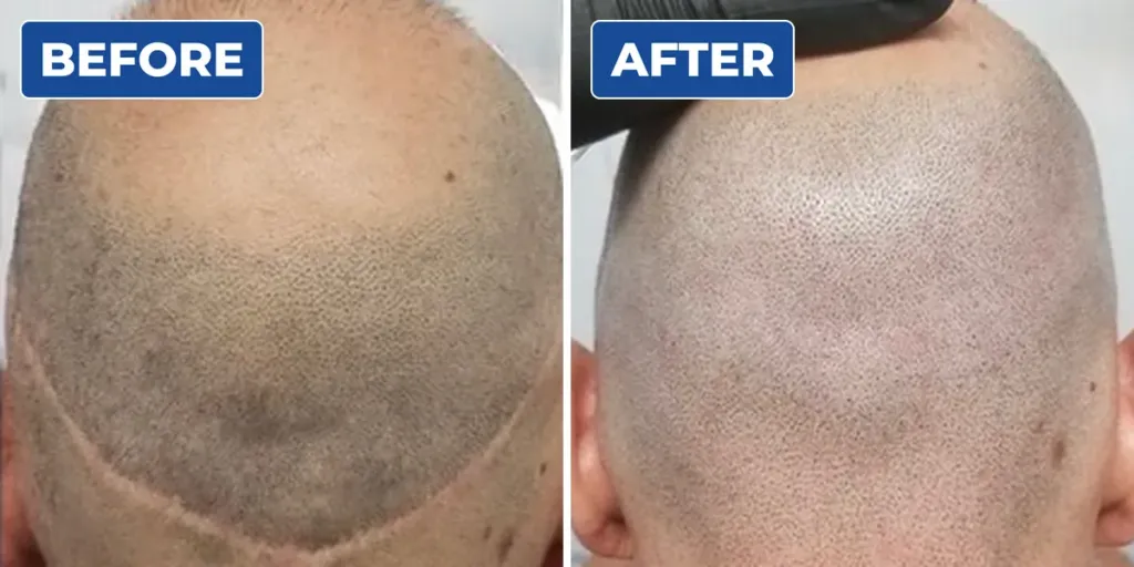Before and after scalp micropigmentation scar camouflage on the back of a man's head, covering a visible hairline scar