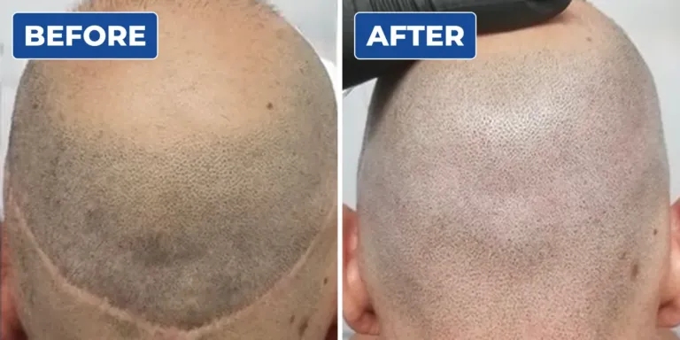 Before and after scalp micropigmentation scar camouflage on the back of a man's head, covering a visible hairline scar